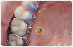 mini implant dentos absoanchor